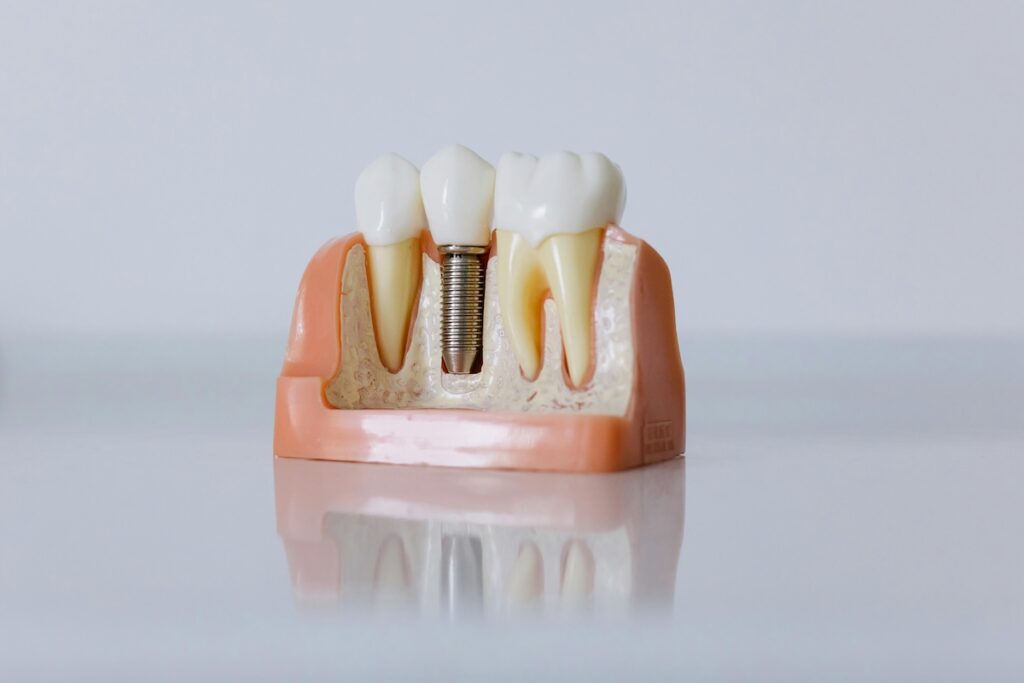 Implantul dentar: când este indicat și cât durează cu adevărat procesul